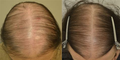 finasteride for women's hair loss reviews